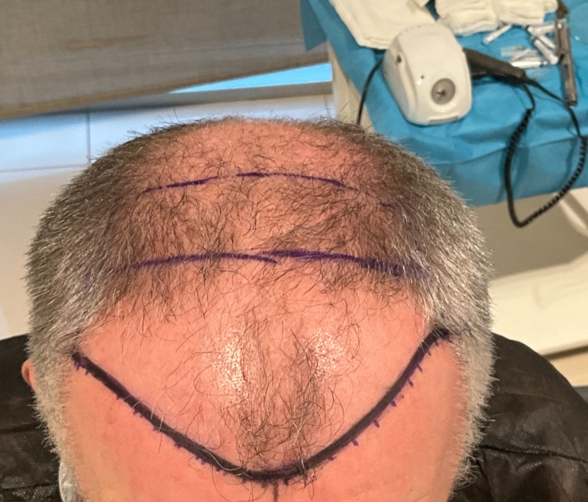 /foren/transplant/index.php/fa/67304/0/[img]/foren/transplant/index.php/fa/67305/0/[img]/foren/transplant/index.php/fa/67306/0/[/img][/img]